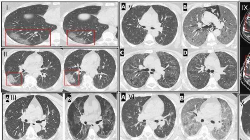 COVID insanlarda nasıl bir hasar bıraktı?