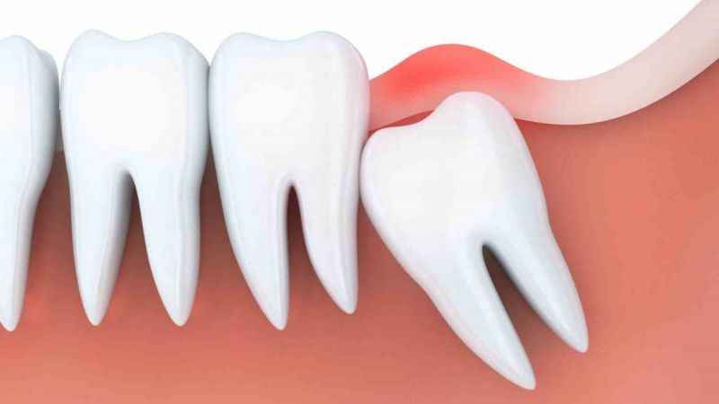 Gömülü dişleri hemen çektirmeyin