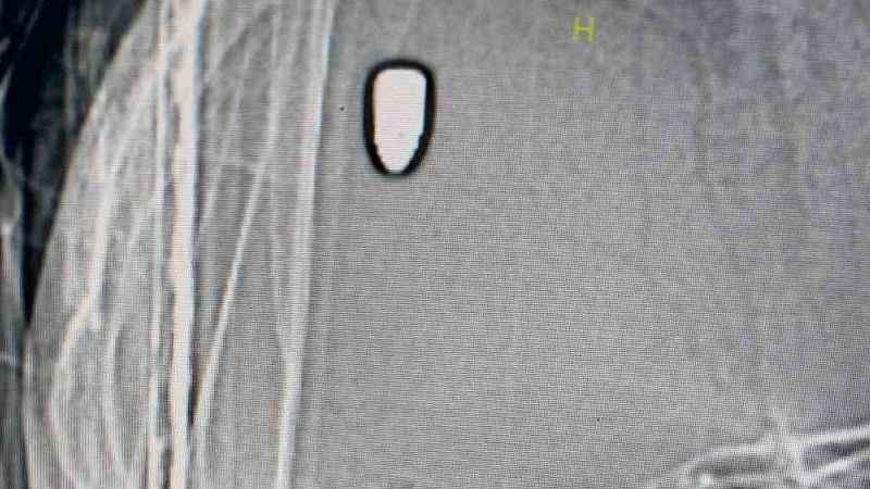 Arkadaşını beklerken kafasına yorgun mermi isabet etti