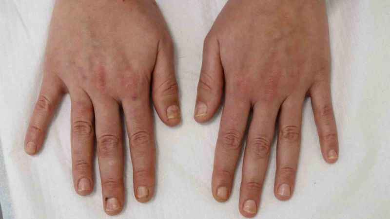 Soğuk havalar deri hastalıklarını da tetikliyor