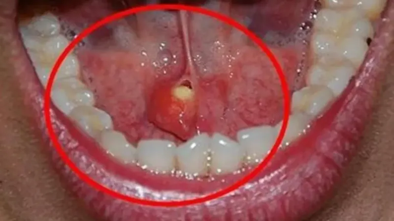 Ağızdaki sessiz tehlike: Tükürük bezi taşı 