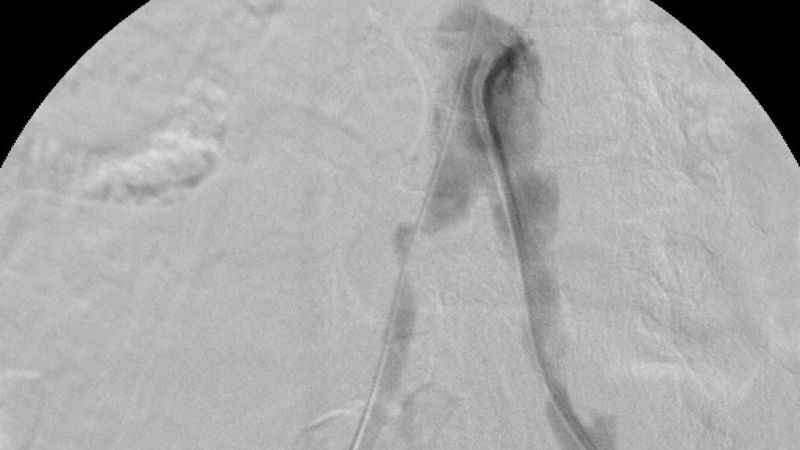 Türkiye’nin ilk yerli stent grefti başarıyla hastalara uygulandı