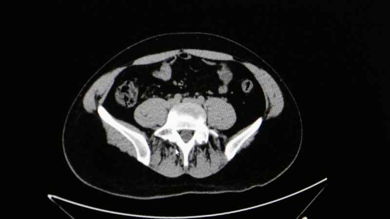 Sıcaklarda idrar yolu enfeksiyonuna dikkat