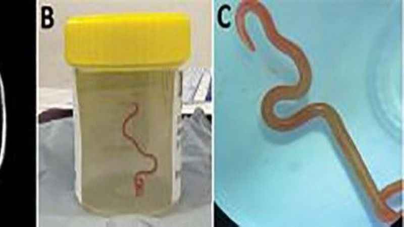 Dünyada ilk: Avustralya'da bir hastanın beyninden canlı solucan çıkarıldı