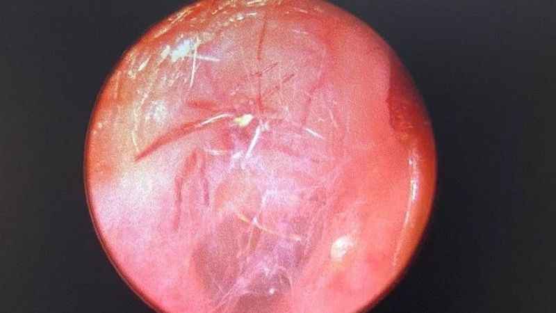 Kulağından canlı örümcek çıktı!