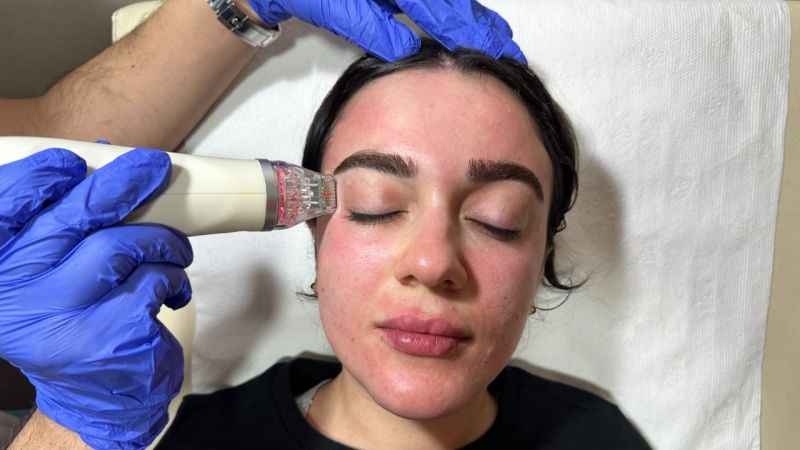 Altın iğne tedavisi ile gelen güzellik