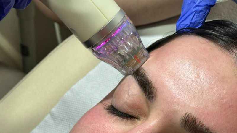 Altın iğne tedavisi ile gelen güzellik