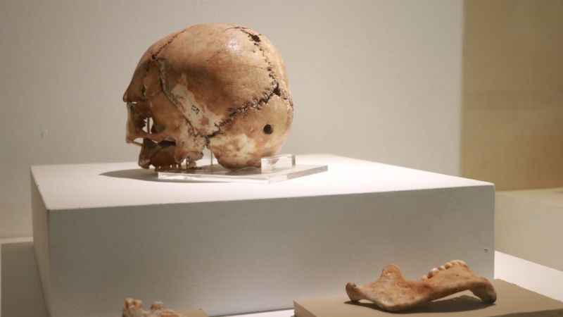 Dünyanın ilk beyin ameliyatı bu kafatasına yapıldı!