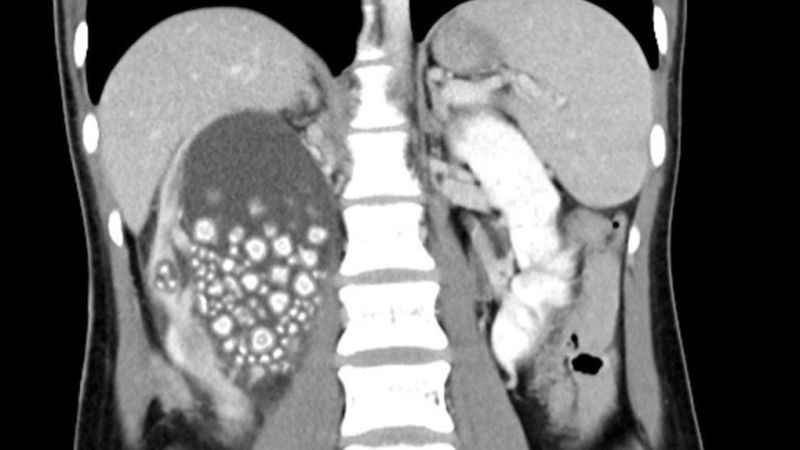 Böbreklerinden 300 adet taş çıkarıldı!