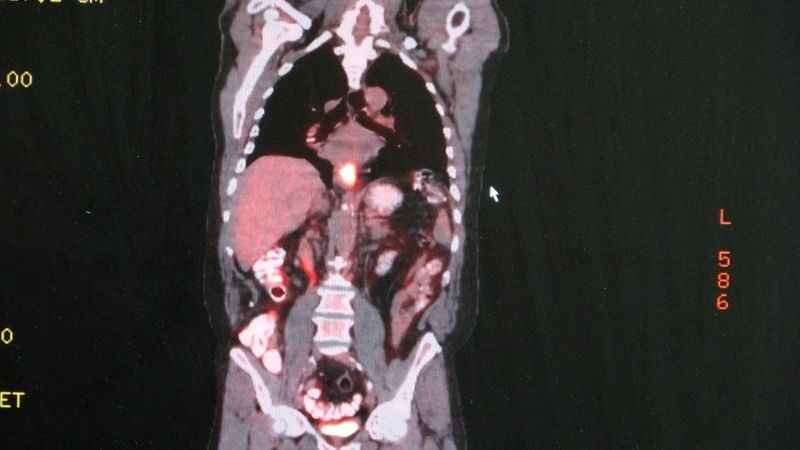 Yemek borusu kanserine dikkat 