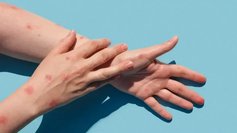 Maymun çiçeği hakkında uzmanından açıklama: Ateş, baş ağrısı ve halsizlik ile başlar