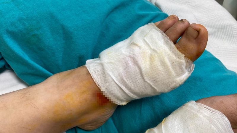 Kızgın Yağ Hastanelik Etti!