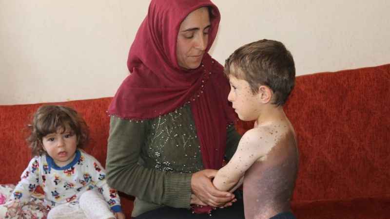 Vücudunu saran dev benlerden kurtulmak istiyor Vücudunu saran dev benlerden kurtulmak istiyor