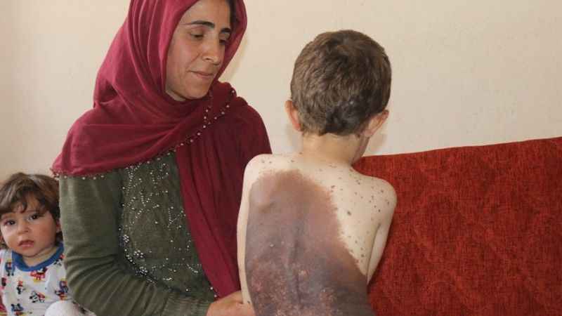 Vücudunu saran dev benlerden kurtulmak istiyor Vücudunu saran dev benlerden kurtulmak istiyor