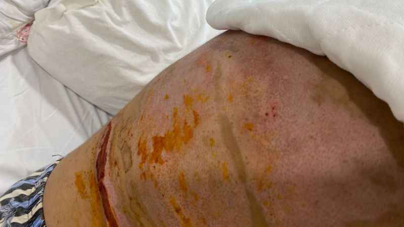 Beyoğlu’nda barda yanmıştı, şimdi durumu iyi