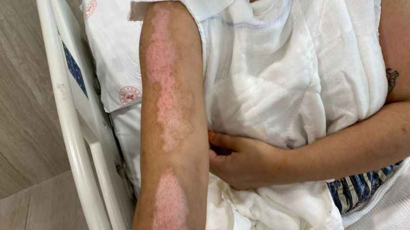 Beyoğlu’nda barda yanmıştı, şimdi durumu iyi