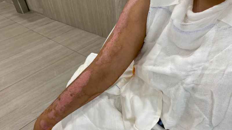 Beyoğlu’nda barda yanmıştı, şimdi durumu iyi