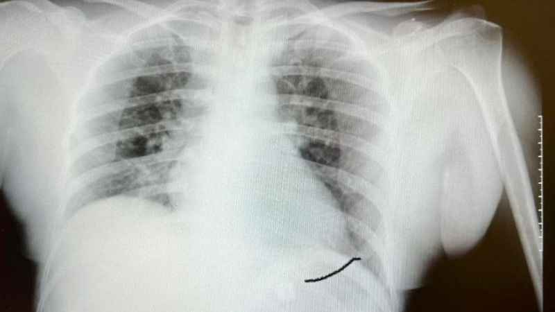 Tıp literatüründe ender görülen olay