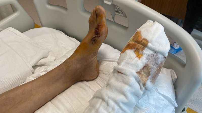 Leke sökücü kullandı, ayağından oluyordu