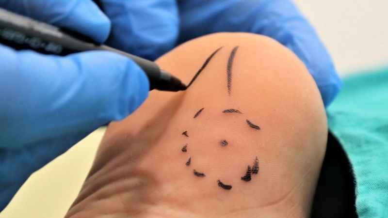 Topuk dikenine dakikalar içerisinde çözüm