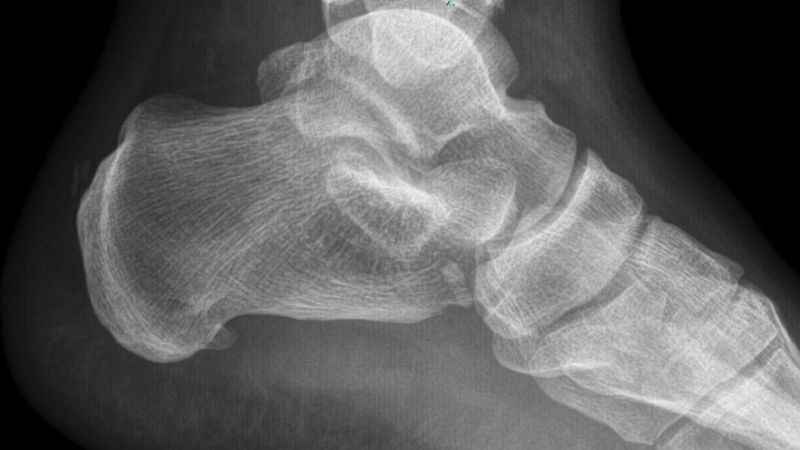 Topuk dikenine dakikalar içerisinde çözüm