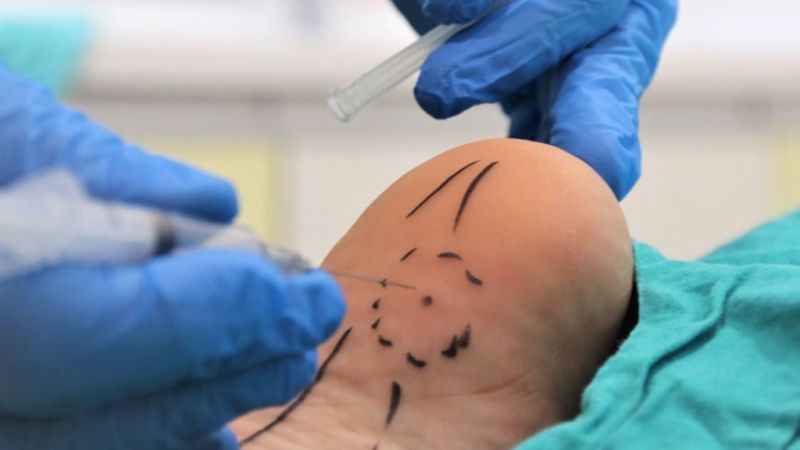 Topuk dikenine dakikalar içerisinde çözüm