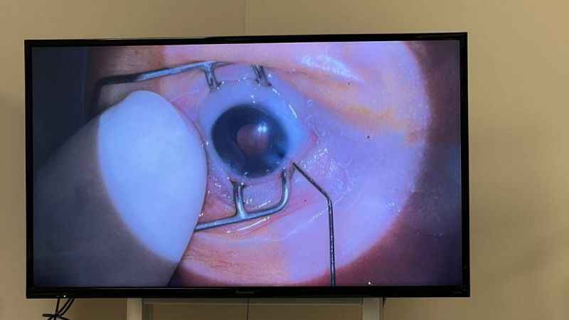 Prematüre bebeğe kuvözde katarakt ameliyatı