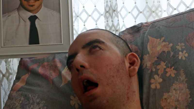 6 ay ömür biçildi, 10 yıldır yaşam savaşı veriyor