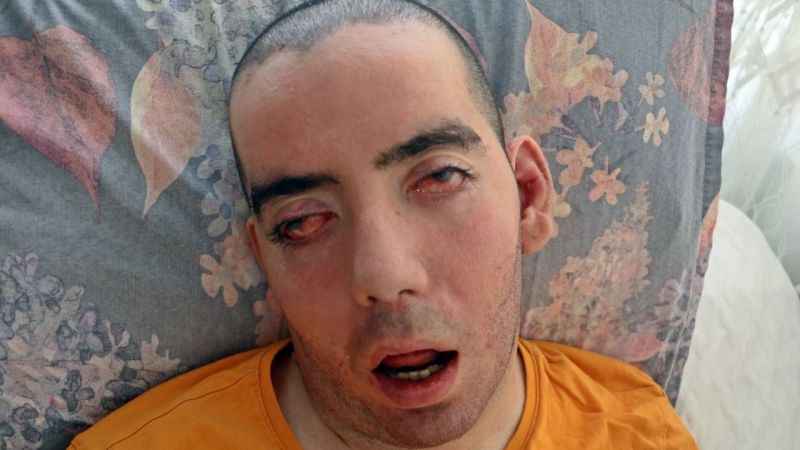 6 ay ömür biçildi, 10 yıldır yaşam savaşı veriyor