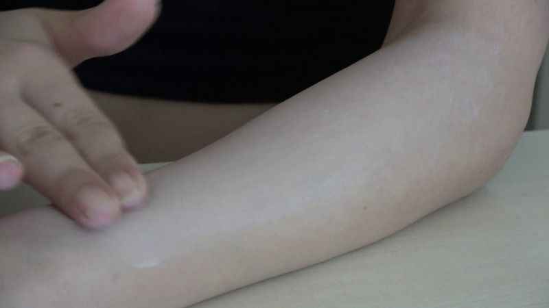 Güneş yanıklarına evde tedavi uygulamayın