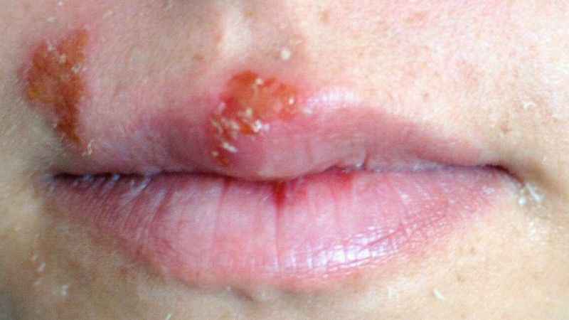 Uçuk deyip geçmeyin