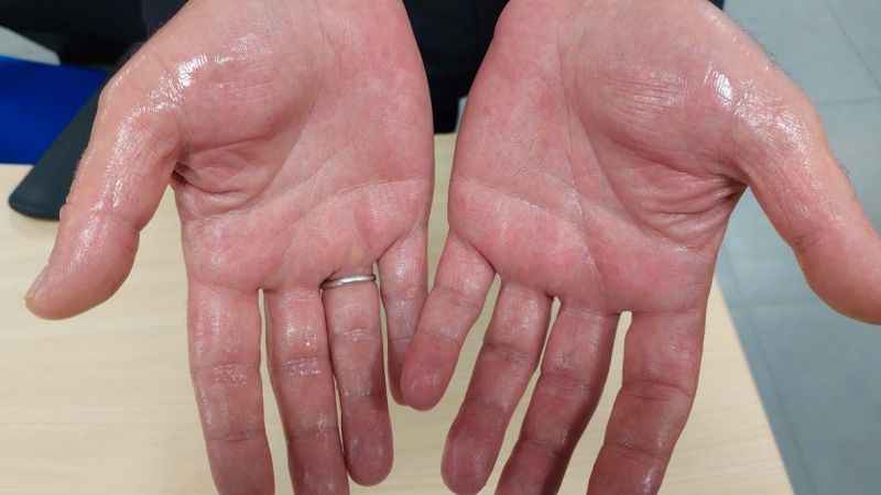 Aşırı terleme sorun olmaktan çıkıyor