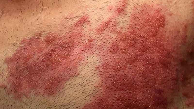 Korona sonrası viral hastalıklar coştu