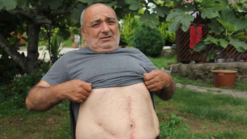 18 yıl boyunca karnındaki gazlı bezle yaşadı