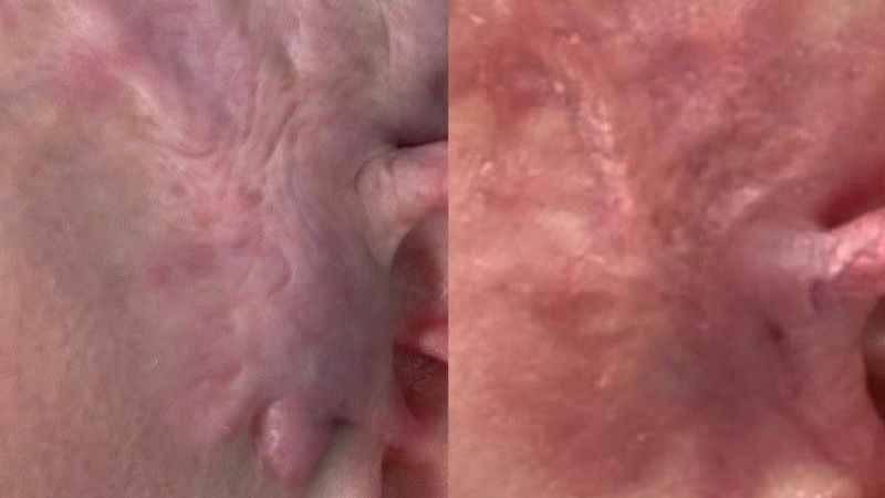 Yanık izlerine lazer tedavisi ile çözüm