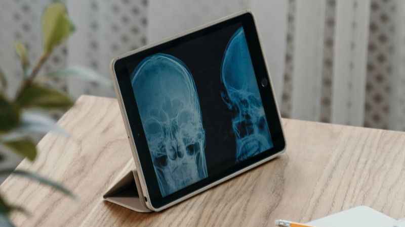 Beyin tümörleri, kan testiyle erken teşhis edilebilecek!