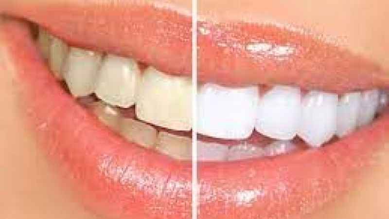  Diş beyazlatma işlemi diş hekimi tarafından yapılmalı