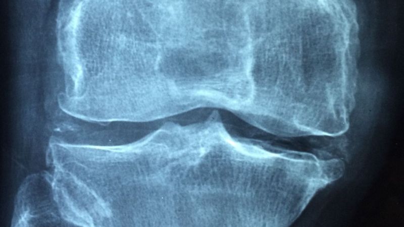 Kemik kırıkları kök hücre ile iyileştiriliyor