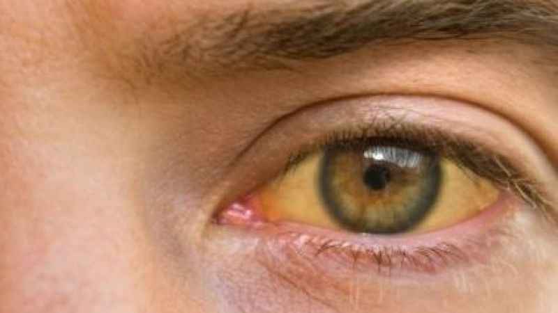 Yazın göz sağlığını korumanın püf noktaları