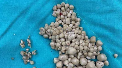 Böbreklerinden 300 adet taş çıkarıldı!