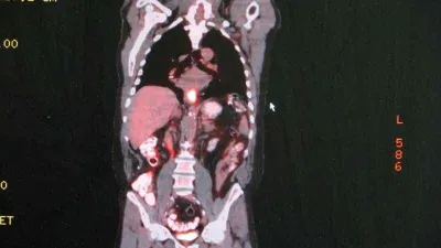 Yemek borusu kanserine dikkat 