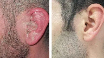 Sedef hastalığının tedavisi kolay