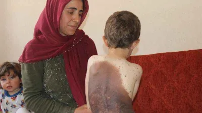 Vücudunu saran dev benlerden kurtulmak istiyor