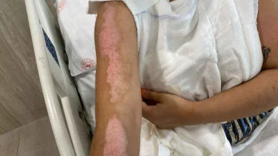 Beyoğlu’nda barda yanmıştı, şimdi durumu iyi