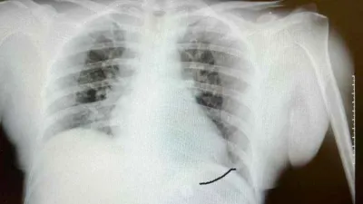 Tıp literatüründe ender görülen olay