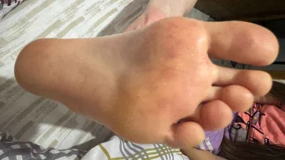 Çocuklarda artan el ayak ağız hastalığına dikkat!