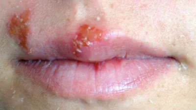 Uçuk deyip geçmeyin