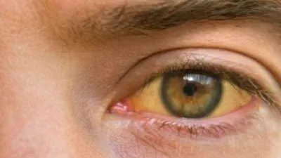 Yazın göz sağlığını korumanın püf noktaları