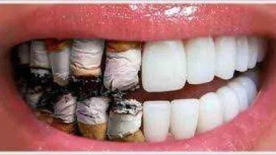 Sigara diş eti hastalıklarını şiddetlendiriyor