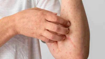 Küresel kızamık tehlikesi yükseliyor: DSÖ Çağrı yaptı